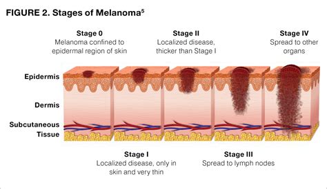 in situ melanoma stages